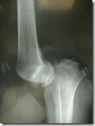 knee dislocation x-ray